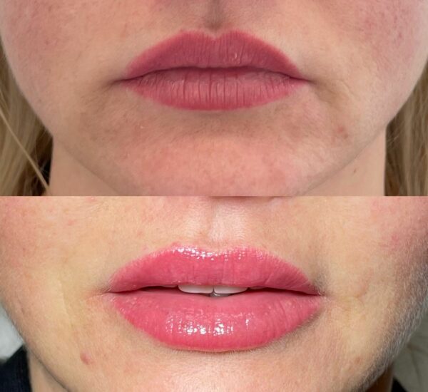 Lip Filler London – Lip Augmentation & Natural Lip Enhancement