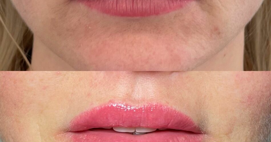 Lip Filler London – Lip Augmentation & Natural Lip Enhancement