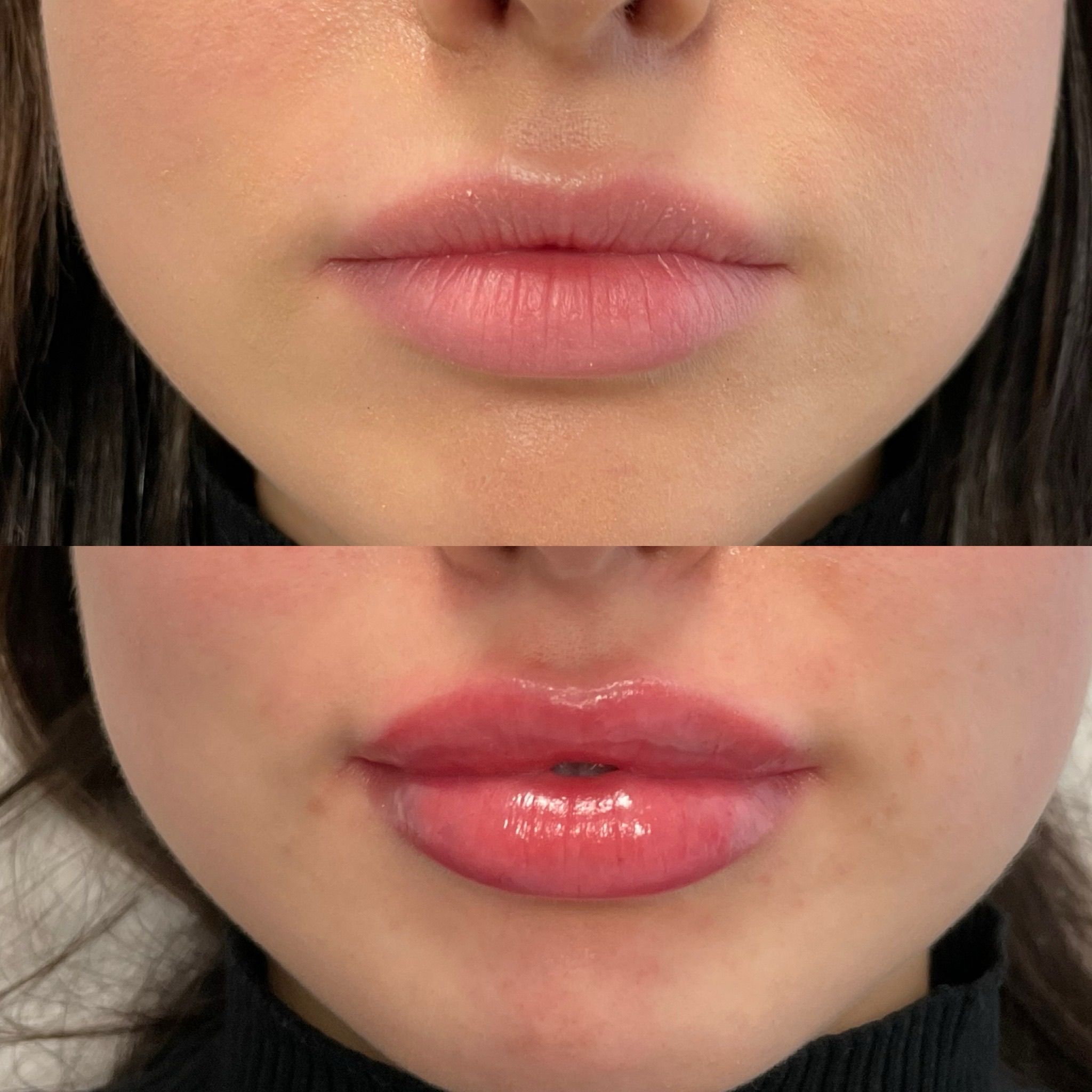 Lip Filler London – Lip Augmentation & Natural Lip Enhancement