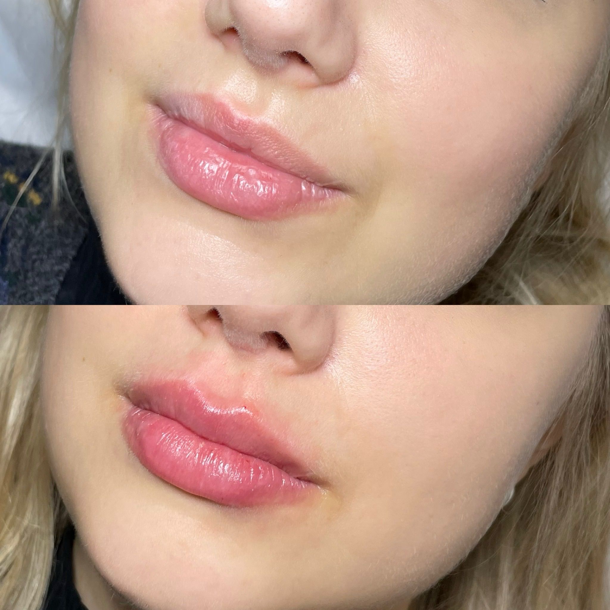 Lip Filler London – Lip Augmentation & Natural Lip Enhancement