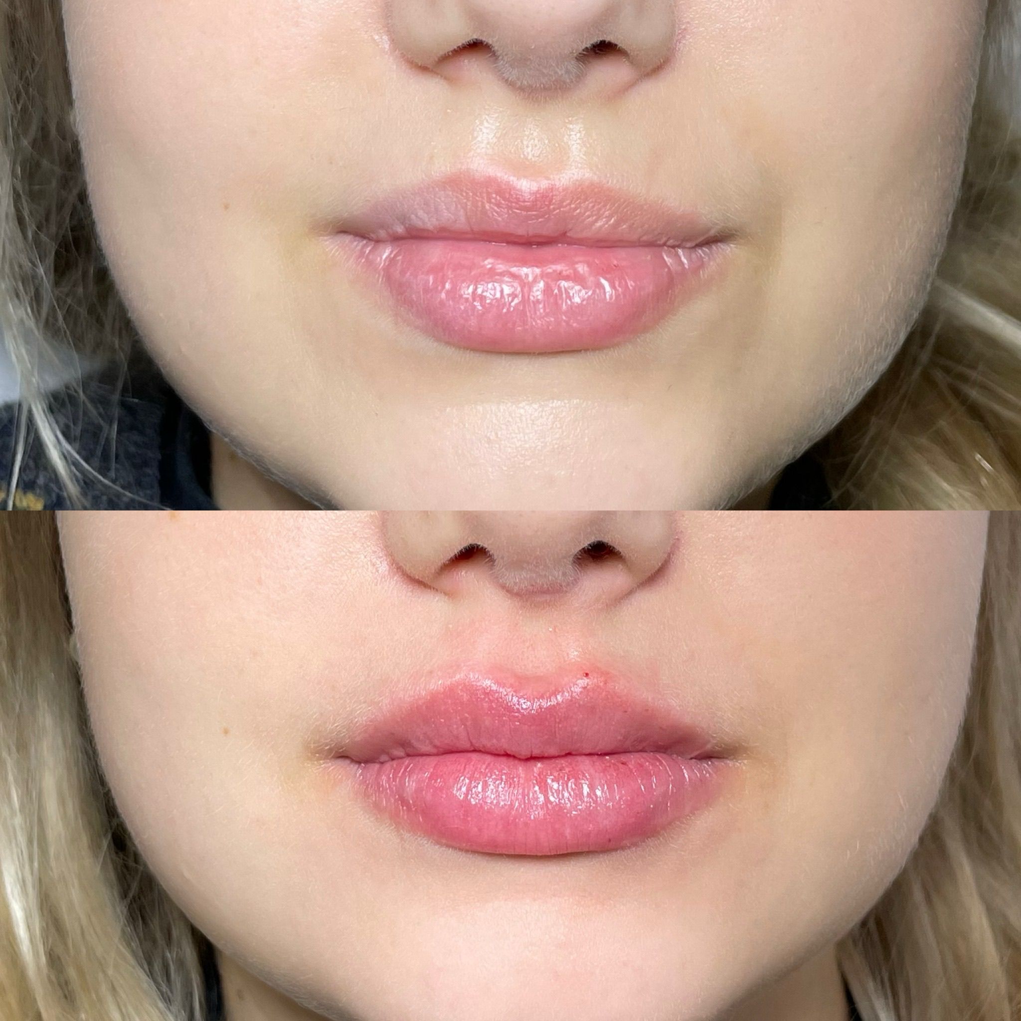 Lip Filler London – Lip Augmentation & Natural Lip Enhancement