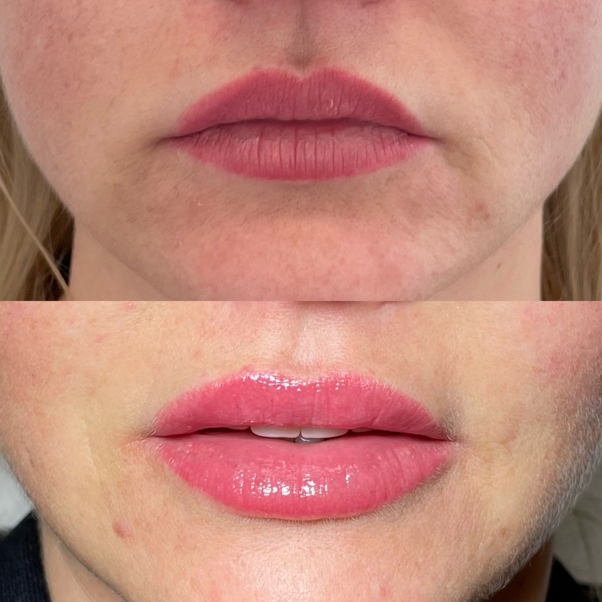 Lip Filler London – Lip Augmentation & Natural Lip Enhancement
