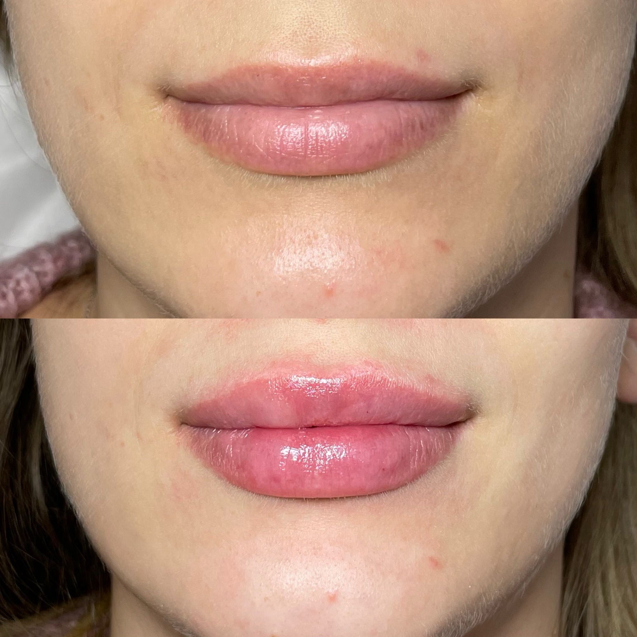 Lip Filler London – Lip Augmentation & Natural Lip Enhancement