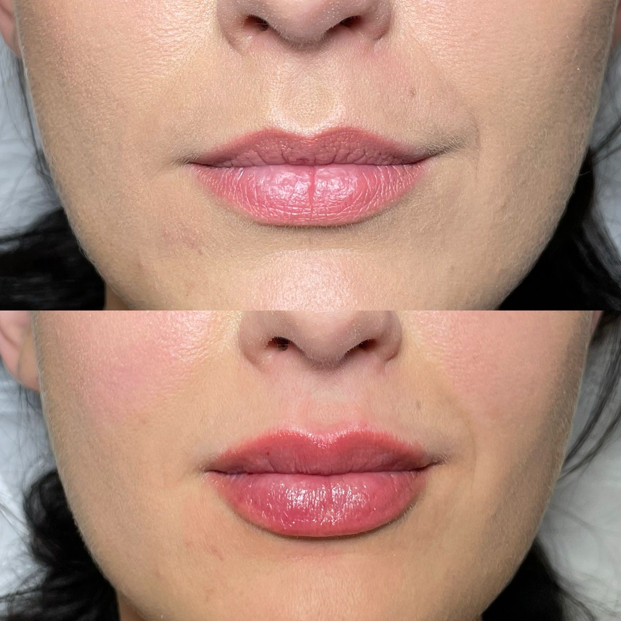 Lip Filler London – Lip Augmentation & Natural Lip Enhancement